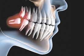 Dente Siso: Quando tirar?