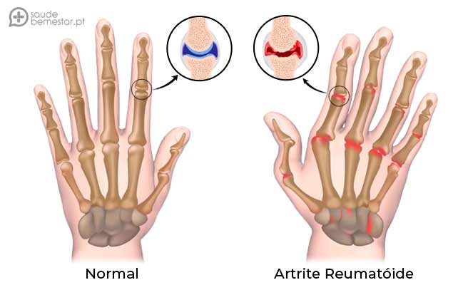 Artrite reumatóide: Sintomas, causas e tratamento