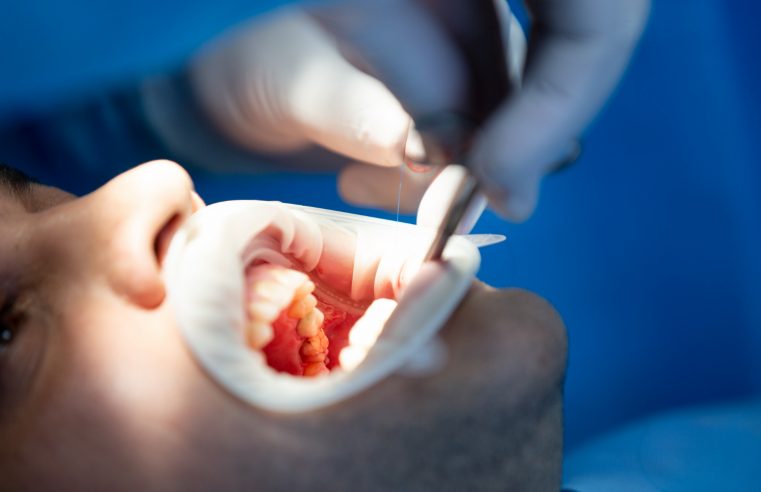 Extração de dente: cuidados importantes para uma boa recuperação