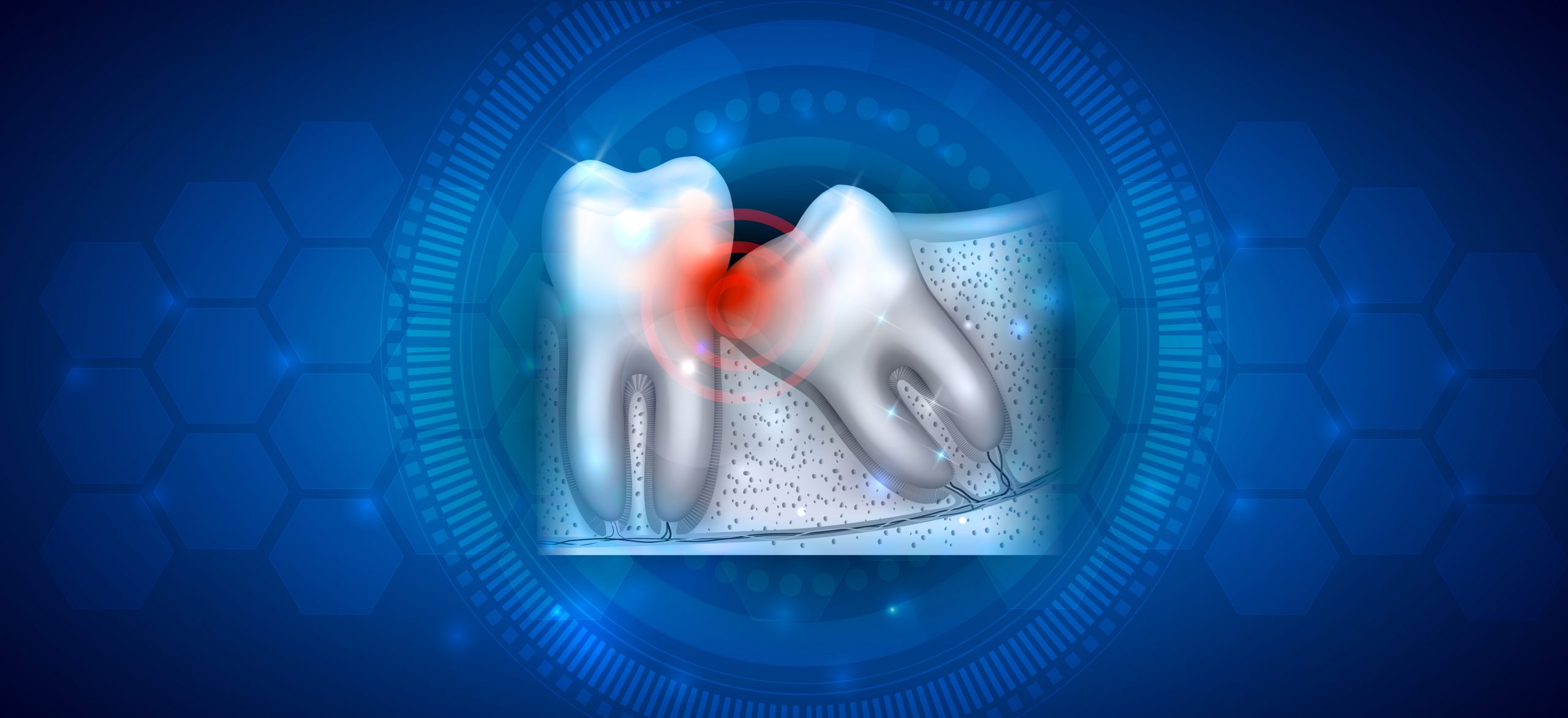 A importância de retirar os dentes do siso