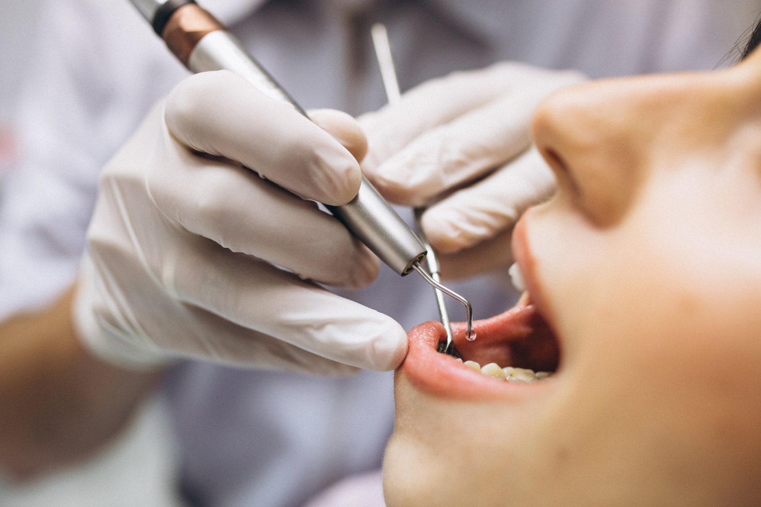 Implante dentário: o que é, como funciona e quais são os benefícios