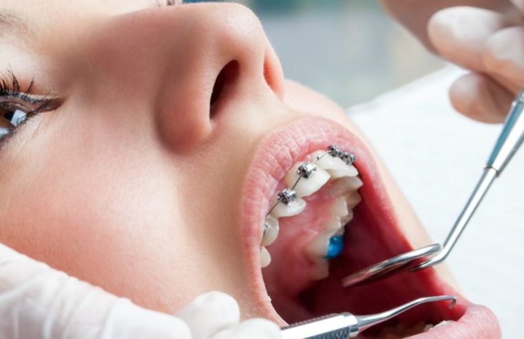 Lentes de Contato Dental: Um Sorriso Transformador