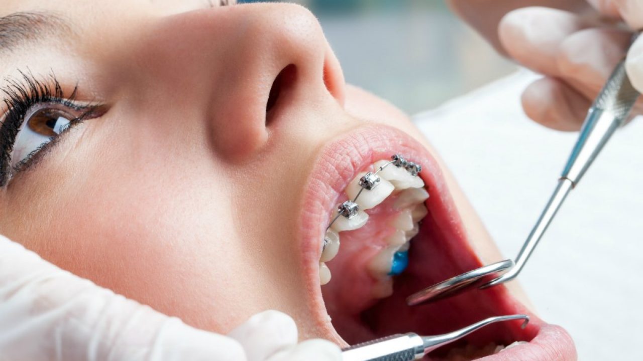 Lentes de Contato Dental: Um Sorriso Transformador