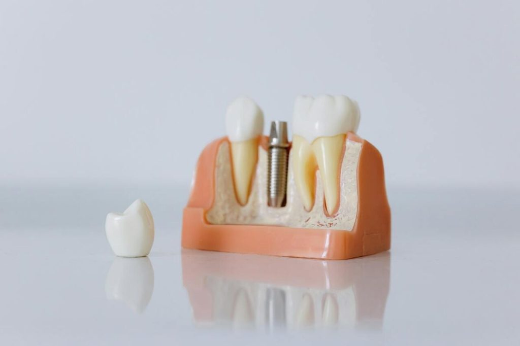 base solida para implante dentário